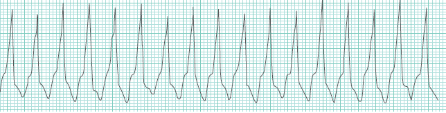 心電図 pvc 心室期外収縮の起源を心電図１２誘導から推定してみる
